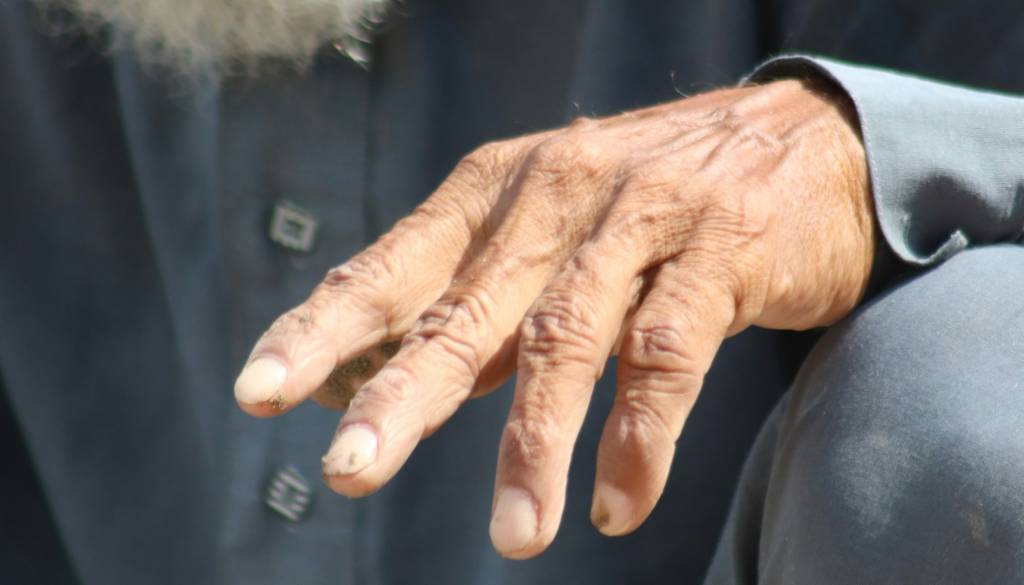 Na Hrvaškem po več kot 30 letih potrdili primer gobavosti