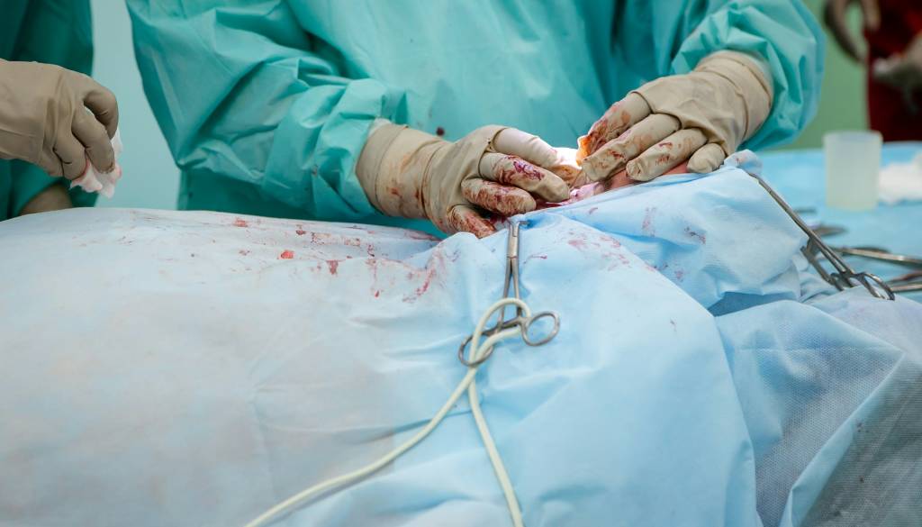 Zdravniki ostali brez besed: Pacientki odstranili 36-kilogramski tumor 