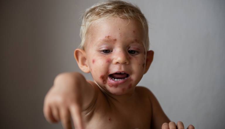 Cepivo, ki je norice v cepljeni populaciji skoraj izbrisalo