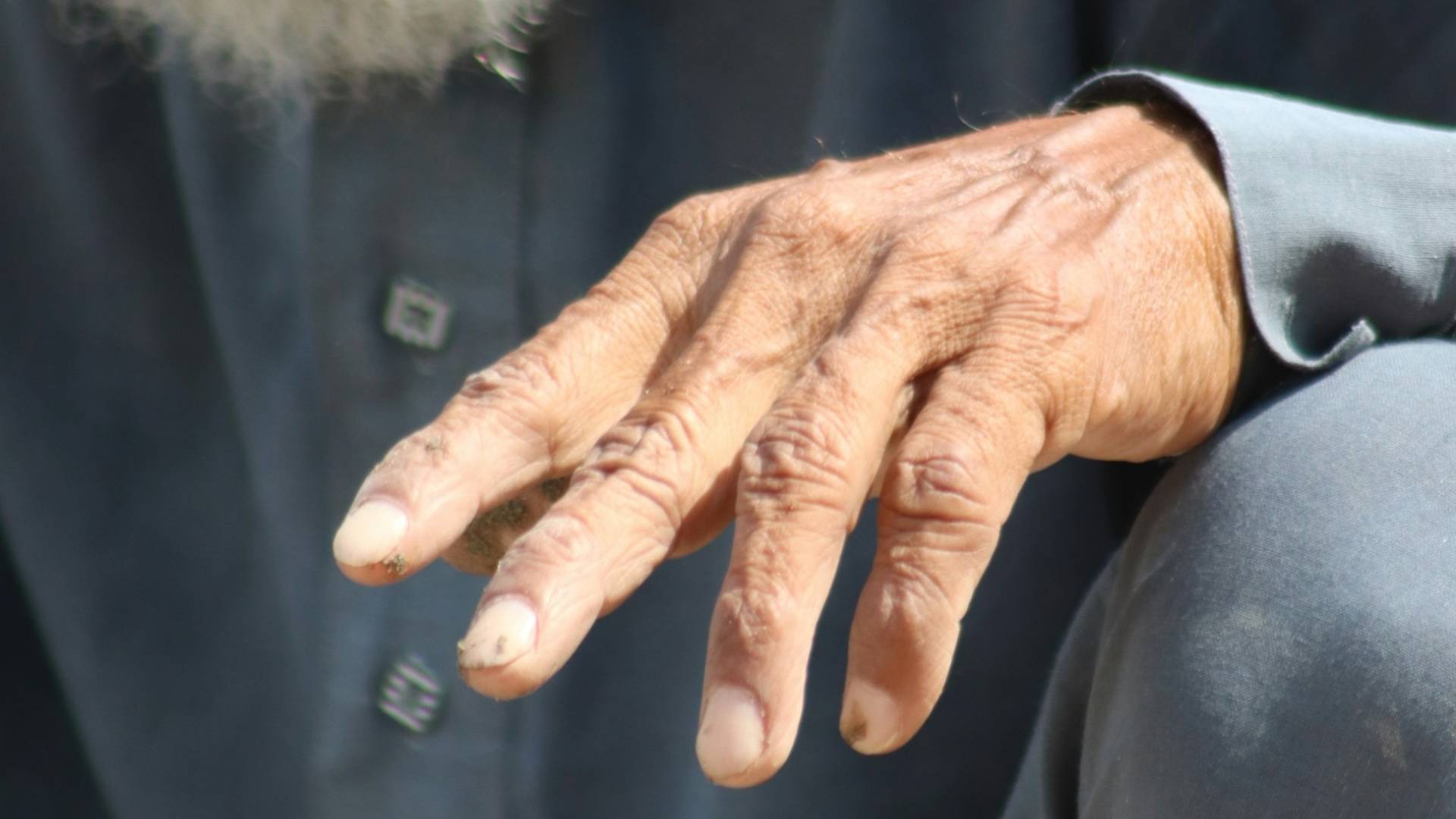 Na Hrvaškem po več kot 30 letih potrdili primer gobavosti